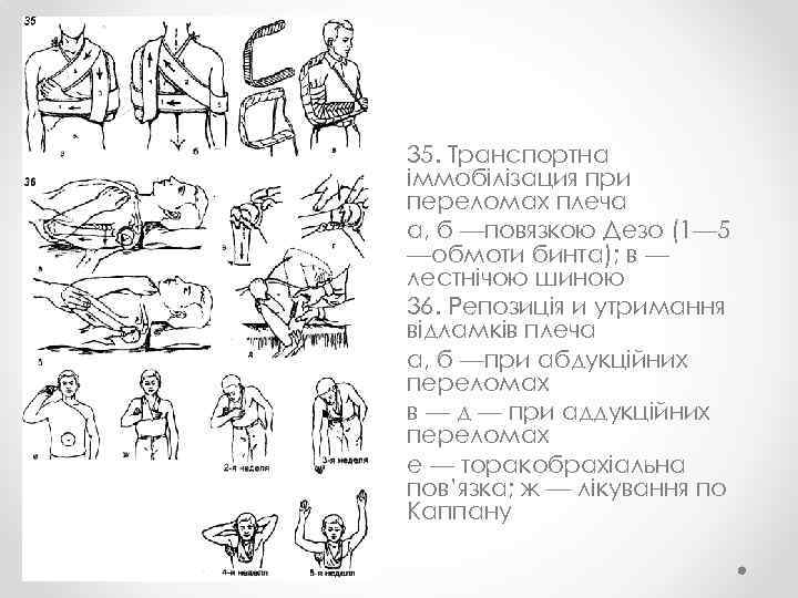 35. Транспортна іммобілізация при переломах плеча а, б —повязкою Дезо (1— 5 —обмоти бинта);