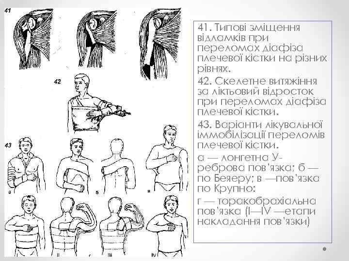 41. Типові зміщення відламків при переломах діафіза плечевої кістки на різних рівнях. 42. Скелетне