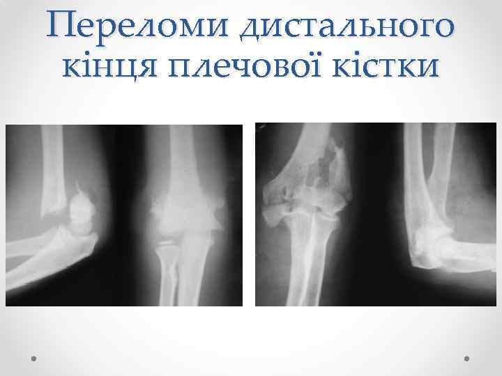 Переломи дистального кінця плечової кістки 