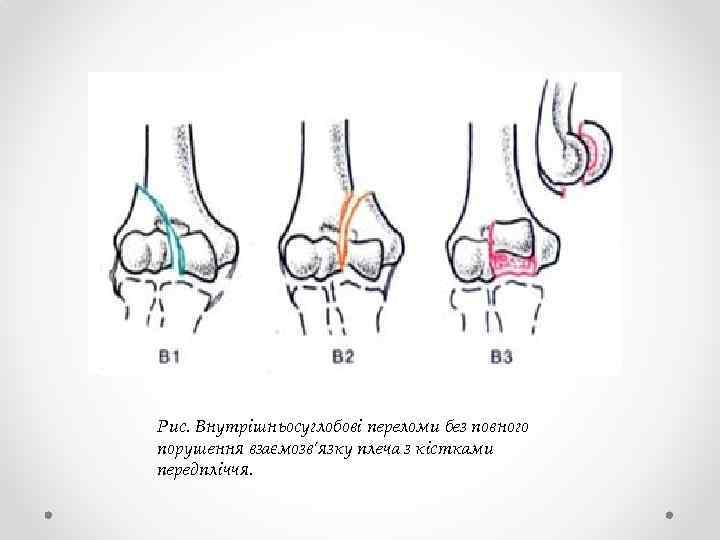 Рис. Внутрішньосуглобові переломи без повного порушення взаємозв’язку плеча з кістками передпліччя. 