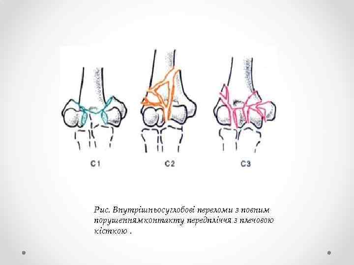 Рис. Внутрішньосуглобові переломи з повним порушеннямконтакту передпліччя з плечовою кісткою. 