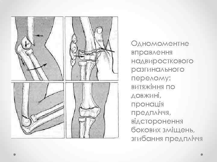 Одномоментне вправлення надвиросткового разгинального перелому: витяжіння по довжині, пронація предпліччя, відсторонення бокових зміщень, згибання