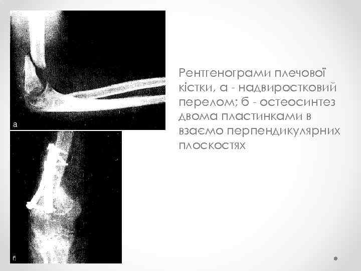Рентгенограми плечової кістки, а - надвиростковий перелом; б - остеосинтез двома пластинками в взаємо