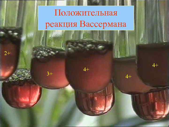 Положительная реакция Вассермана 2+ 3+ 4+ 4+ 4+ 