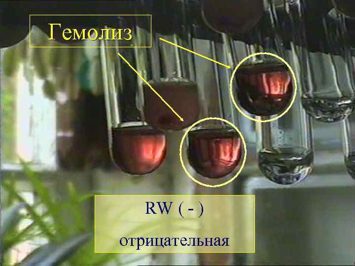 Гемолиз RW ( - ) отрицательная 