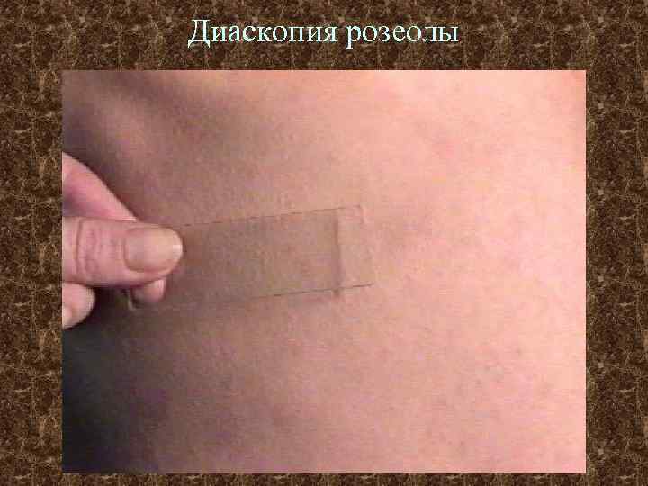 Диаскопия розеолы 