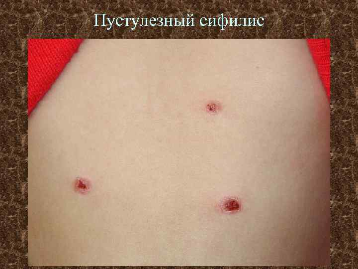 Пустулезный сифилис 