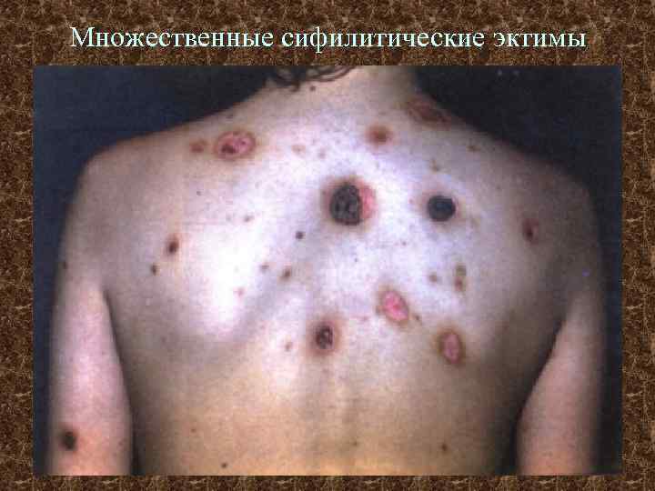 Множественные сифилитические эктимы 