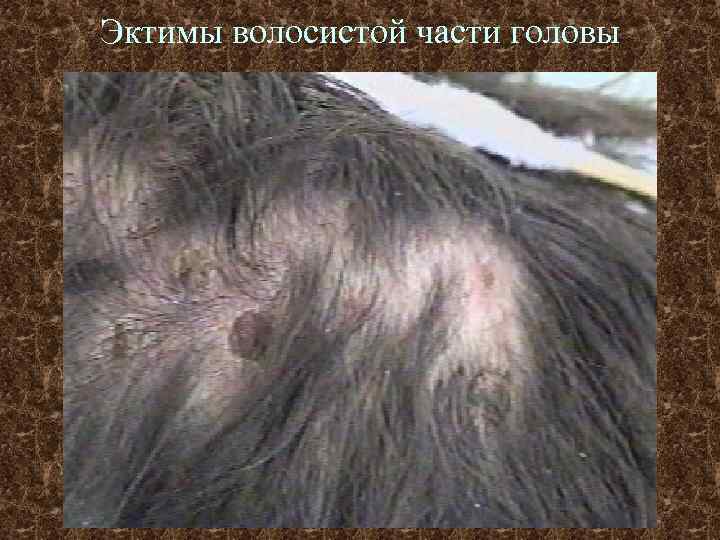 Эктимы волосистой части головы 