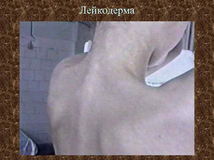 Лейкодерма 