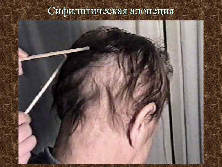 Сифилитическая алопеция 