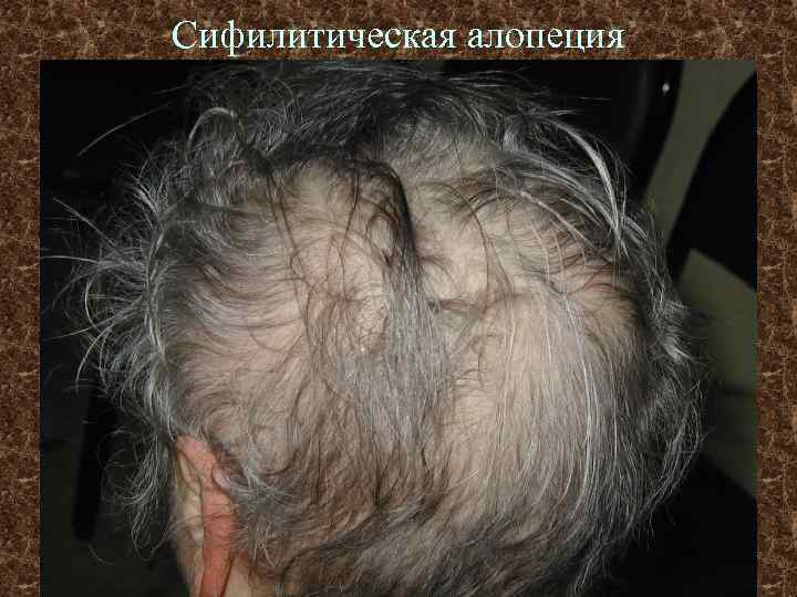 Сифилитическая алопеция 
