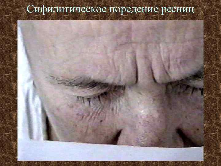 Сифилитическое поредение ресниц 