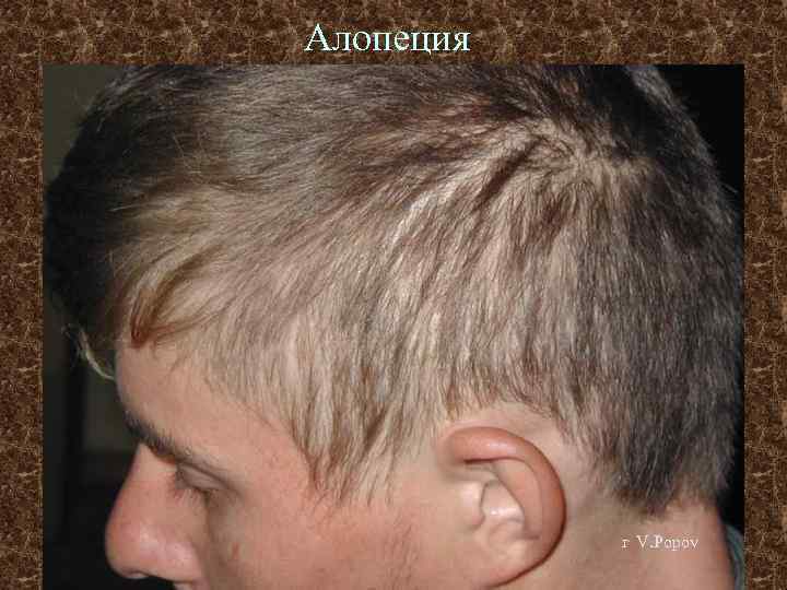 Алопеция г V. Popov 