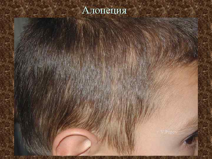 Алопеция г V. Popov 