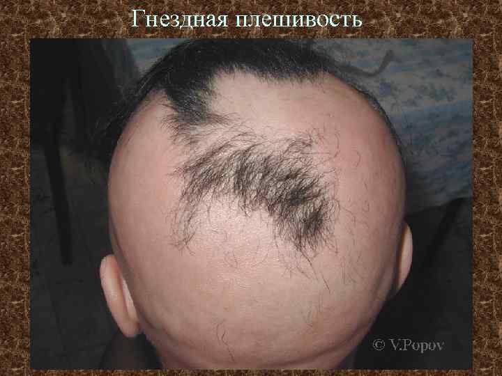 Гнездная плешивость 