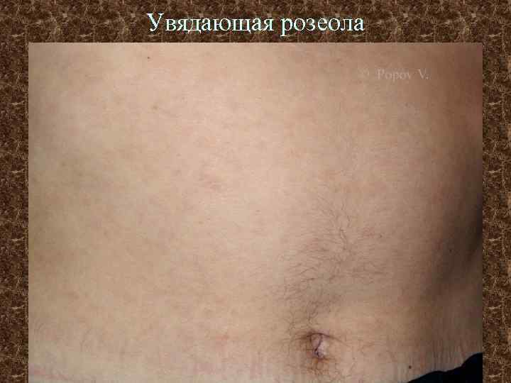 Увядающая розеола 