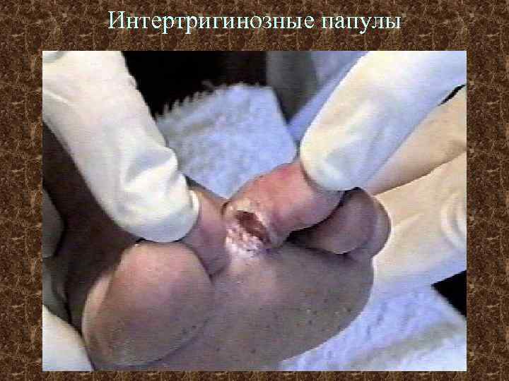 Интертригинозные папулы 