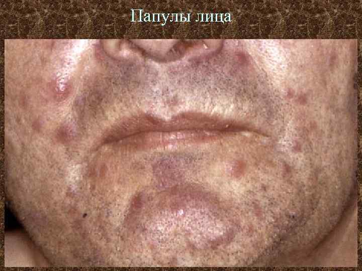 Папулы лица 
