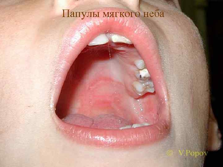 Папулы мягкого неба 