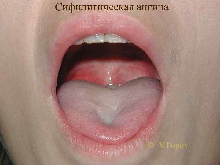 Сифилитическая ангина 