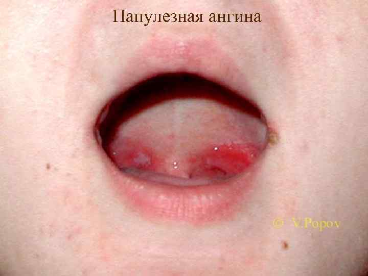 Папулезная ангина 