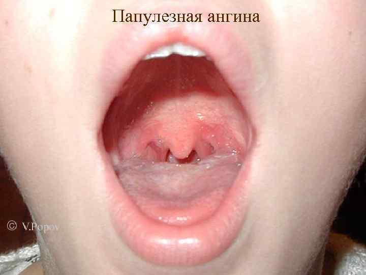 Папулезная ангина 