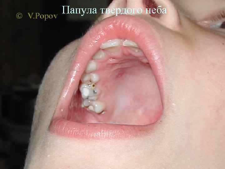 Папула твердого неба 