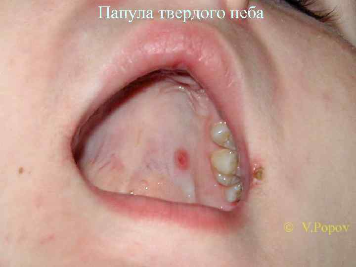 Папула твердого неба 