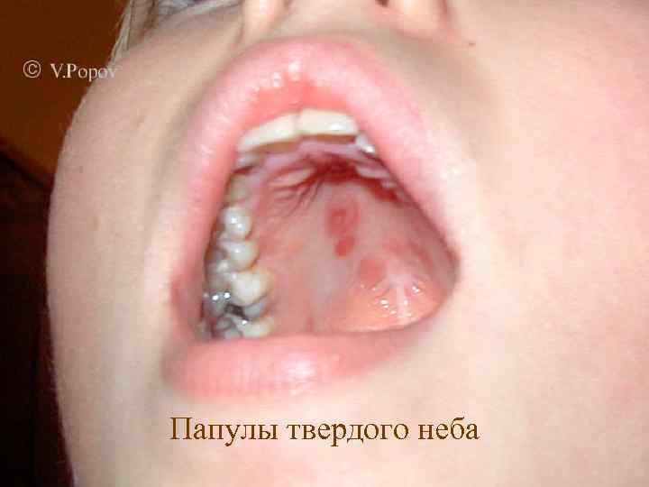 Папулы твердого неба 