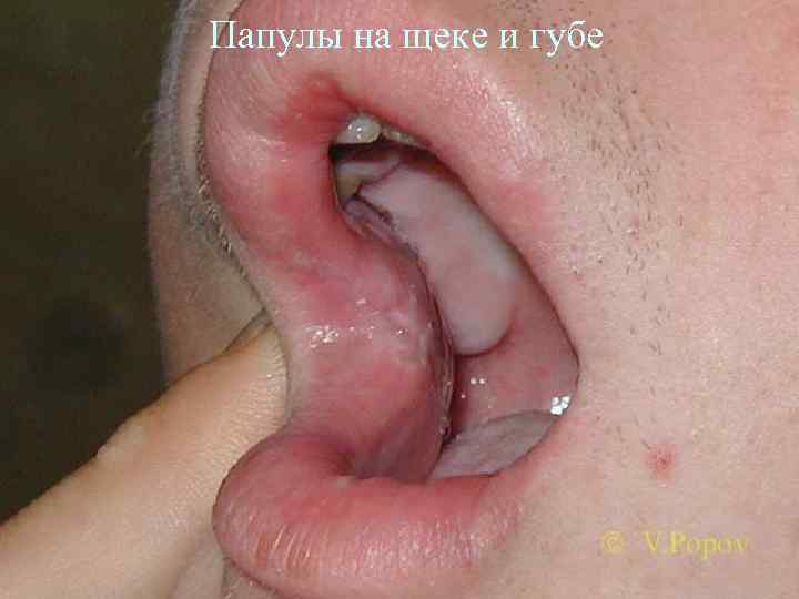 Папулы на щеке и губе 