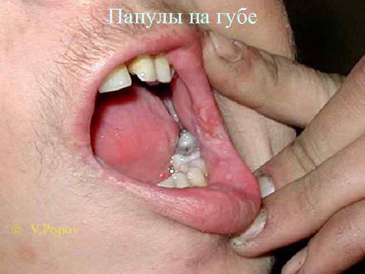 Папулы на губе 