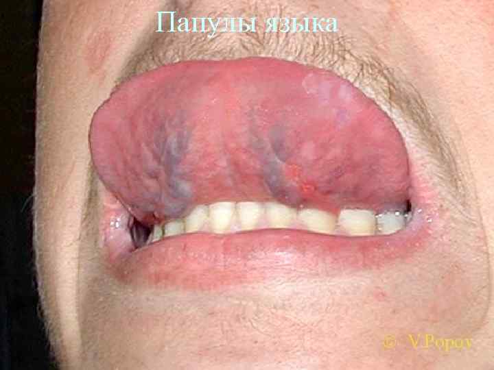Папулы языка 