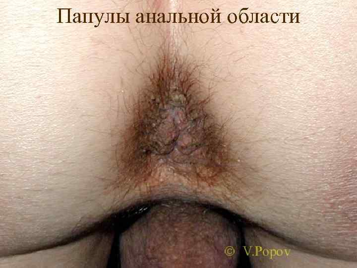 Папулы анальной области 