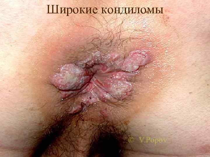 Широкие кондиломы 