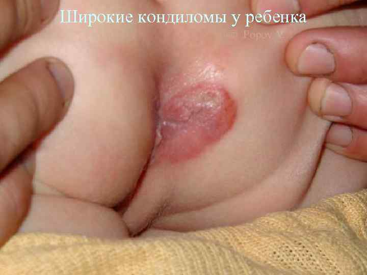 Широкие кондиломы у ребенка 