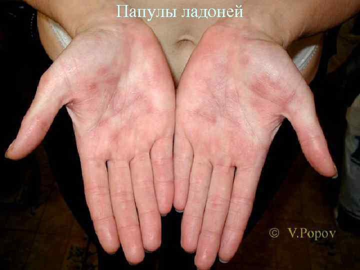Папулы ладоней 