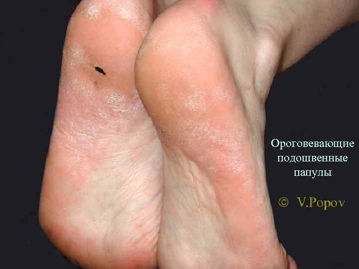 Ороговевающие подошвенные папулы 