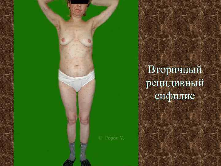 Вторичный рецидивный сифилис 