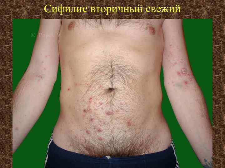 Сифилис вторичный свежий 
