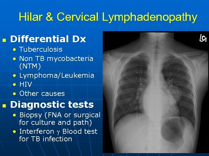 Hilar & Cervical Lymphadenopathy n Differential Dx • • Tuberculosis Non TB mycobacteria (NTM)