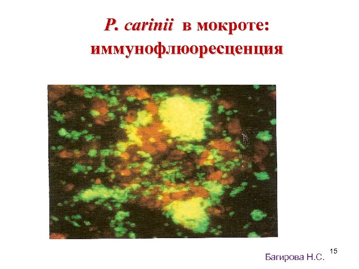 P. carinii в мокроте: иммунофлюоресценция Багирова Н. С. 15 