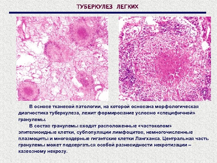 ТУБЕРКУЛЕЗ ЛЕГКИХ В основе тканевой патологии, на которой основана морфологическая диагностика туберкулеза, лежит формирование