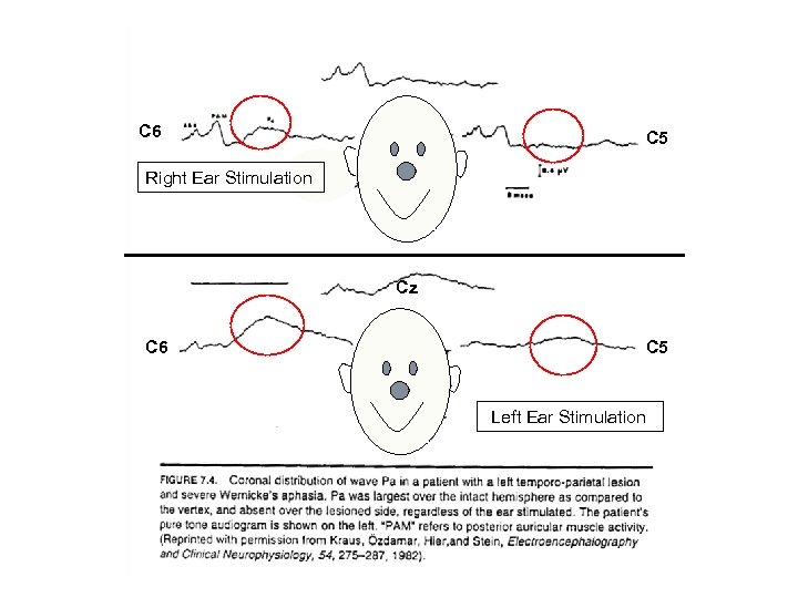 1. C 6 C 5 Right Ear Stimulation Cz C 6 C 5 Left