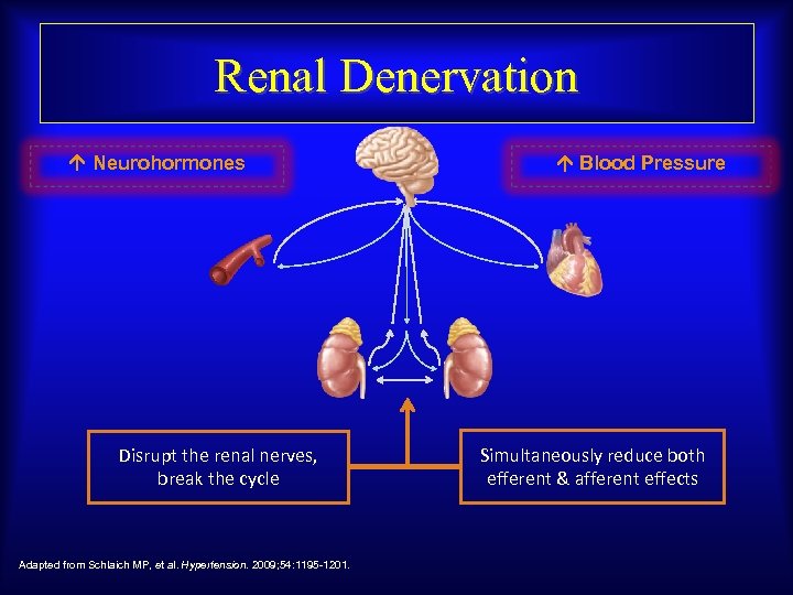 Renal Denervation Neurohormones Disrupt the renal nerves, break the cycle Adapted from Schlaich MP,
