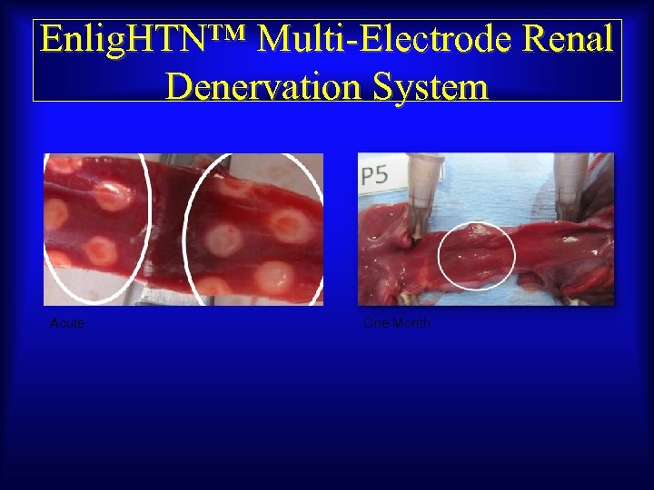 Enlig. HTN™ Multi-Electrode Renal Denervation System Acute One Month 