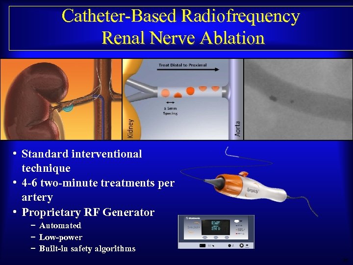Catheter-Based Radiofrequency Renal Nerve Ablation • Standard interventional technique • 4 -6 two-minute treatments