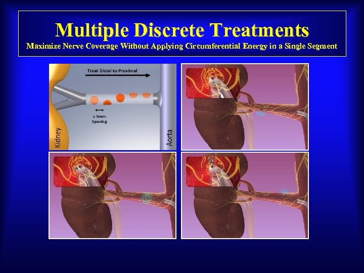 Multiple Discrete Treatments Maximize Nerve Coverage Without Applying Circumferential Energy in a Single Segment