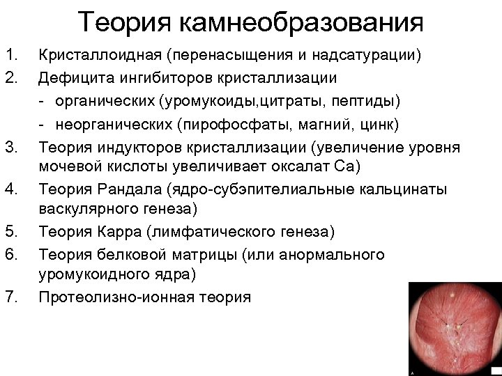 Теория камнеобразования 1. 2. 3. 4. 5. 6. 7. Кристаллоидная (перенасыщения и надсатурации) Дефицита