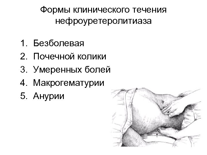 Формы клинического течения нефроуретеролитиаза 1. 2. 3. 4. 5. Безболевая Почечной колики Умеренных болей
